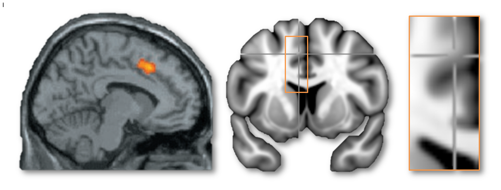 Is it dACC/MCC or not? MNI coordinates -6/8/45. Left panel is from Eisenberger’s well-known cyberball paper (https://tinyurl.com/hxfr64w). Middle and right panels show the same coordinate in a coronal view on the MNI152 template.